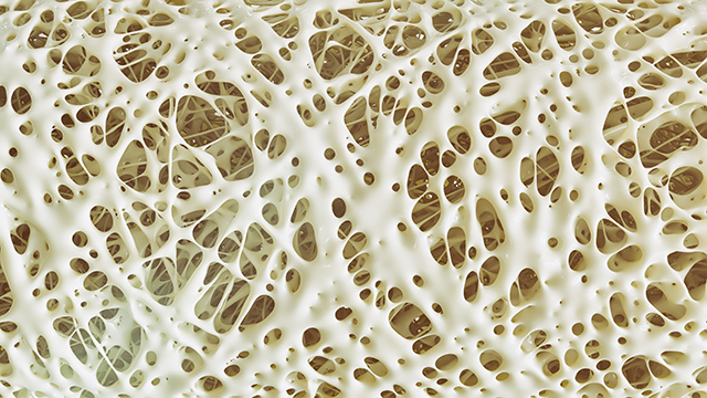 Falls, inactivity and lifestyle habits: 10 Risk factors that can increase osteoporosis risk